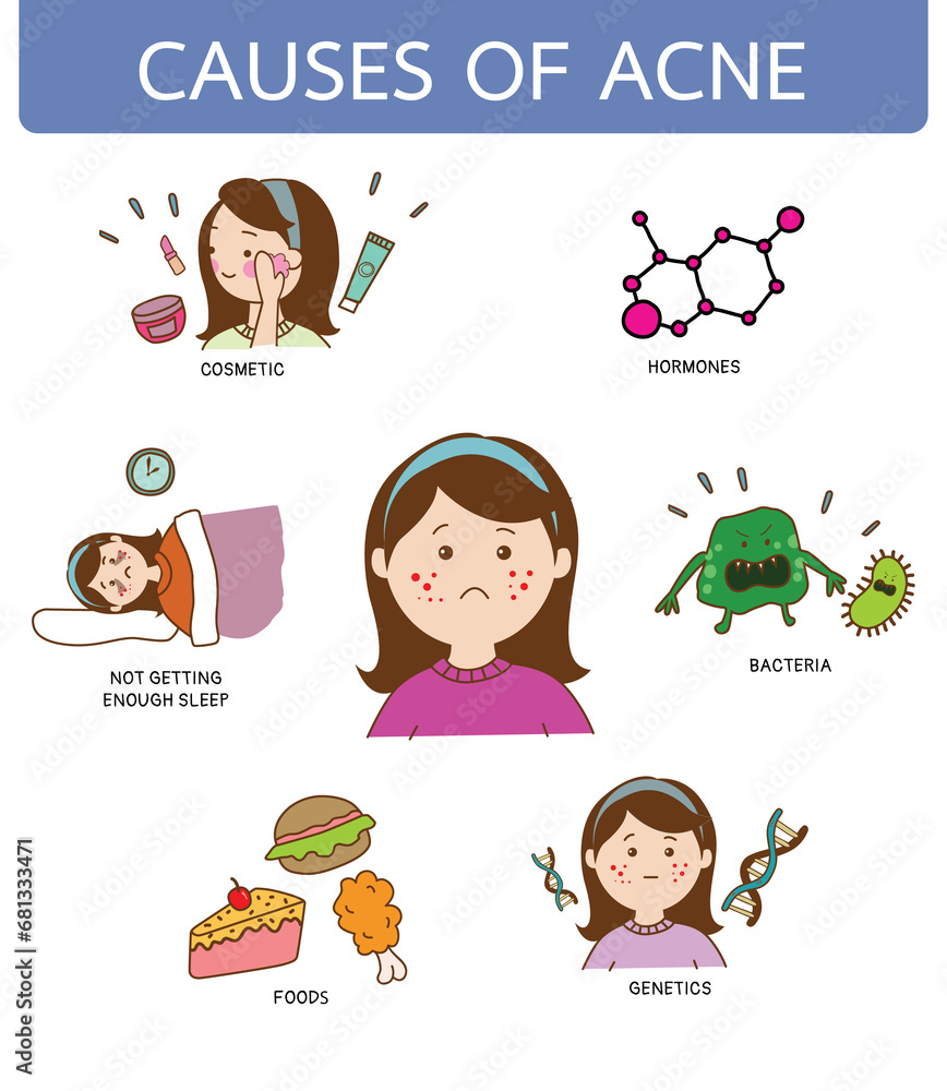 Fototapeta premium Causes of acne on women's face, illustration cartoon on white background