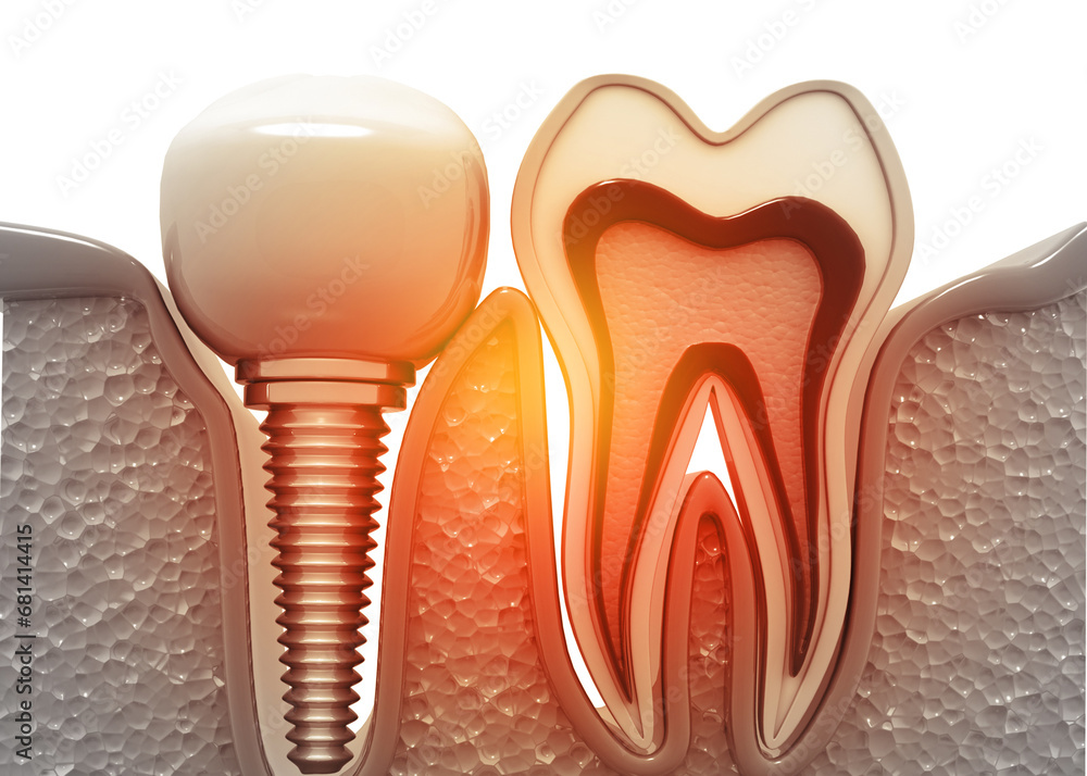 Dental implant and cross section of tooth. 3d illustration.. Dental implant and cross section of tooth. 3d illustration..