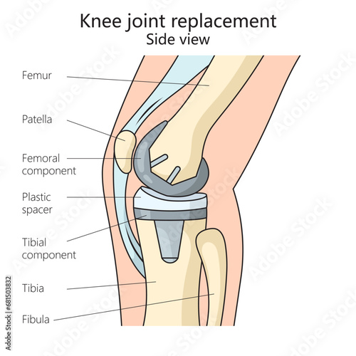 knee joint replacement structure diagram hand drawn schematic vector illustration. Medical science educational illustration