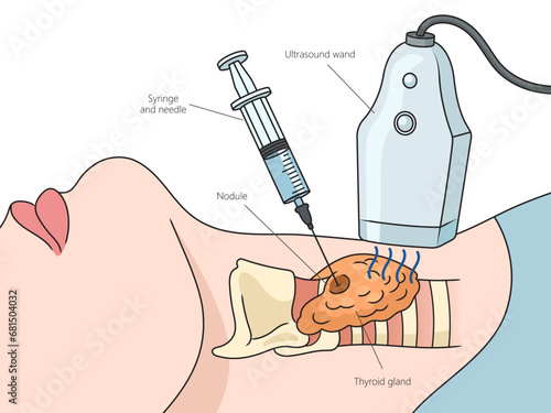 Ultrasound guided thyroid biopsy puncture structure diagram hand drawn schematic vector illustration. Medical science educational illustration