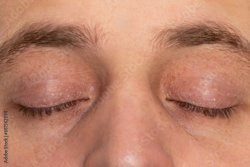 Milia or milium on the upper and lower eyelids of a man. Whiteheads, papillomas, pimples, millet, wen, cysts on the skin around the eyes. Face close-up. Dermatology and skin care photo