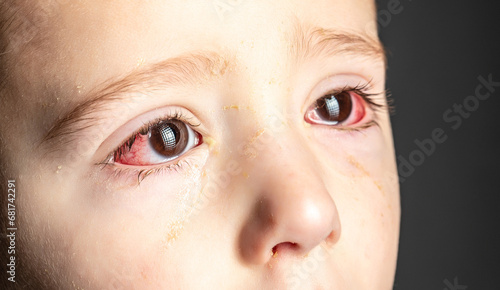 Foto red eye of a patient with human conjunctivitis, ill allergic eyes in babies, chi