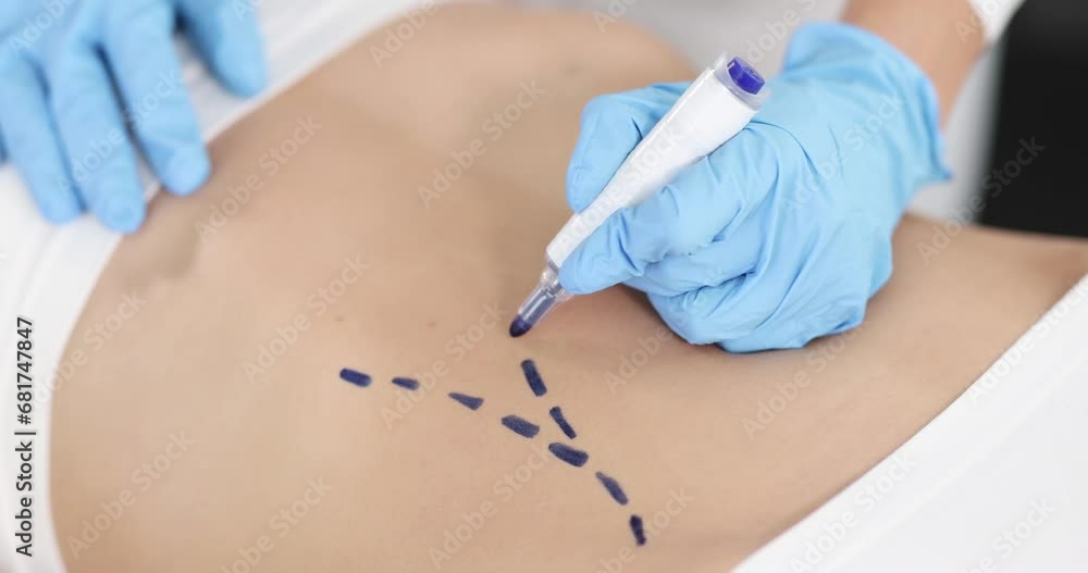 Plastic surgeon drawing preoperative markings on patient abdomen closeup 4k movie slow motion. Plastic surgery and aesthetic medicine liposuction concept Plastic surgeon drawing preoperative markings on patient abdomen closeup 4k movie slow motion. Plastic surgery and aesthetic medicine liposuction concept