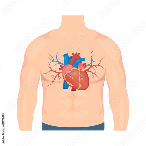 Atherosclerosis concept. Human heart. Medical vector illustration