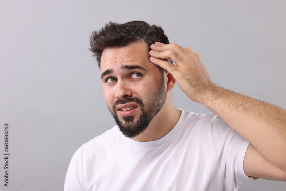 Emotional man with dandruff in his dark hair on light grey background Emotional man with dandruff in his dark hair on light grey background