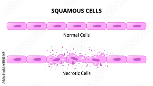 Squamous Cells - Normal Epithelial Cell - Necrotic Cell - Histology Medical Vector Illustration