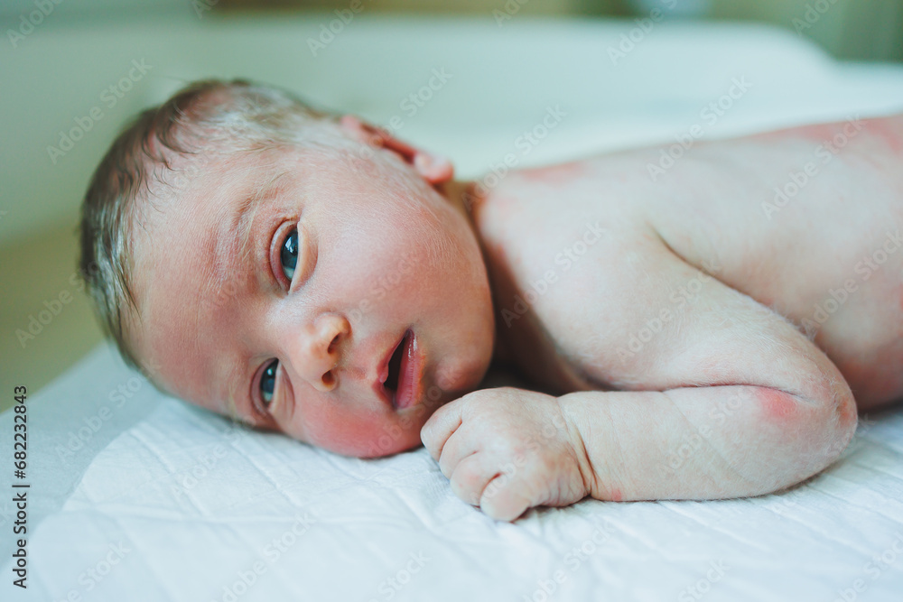 A newborn baby is lying on a diaper with a red rash on his body