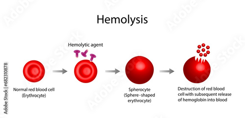 Hemolysis. Normal red blood cell, spherocyte, then destruction of red blood cell with subsequent release of hemoglobin into blood. Vector illustration