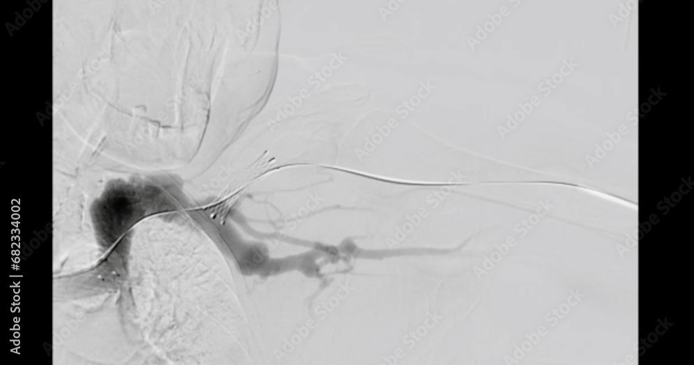 Balloon Angioplasty is a medical procedure used to widen narrowed or ...