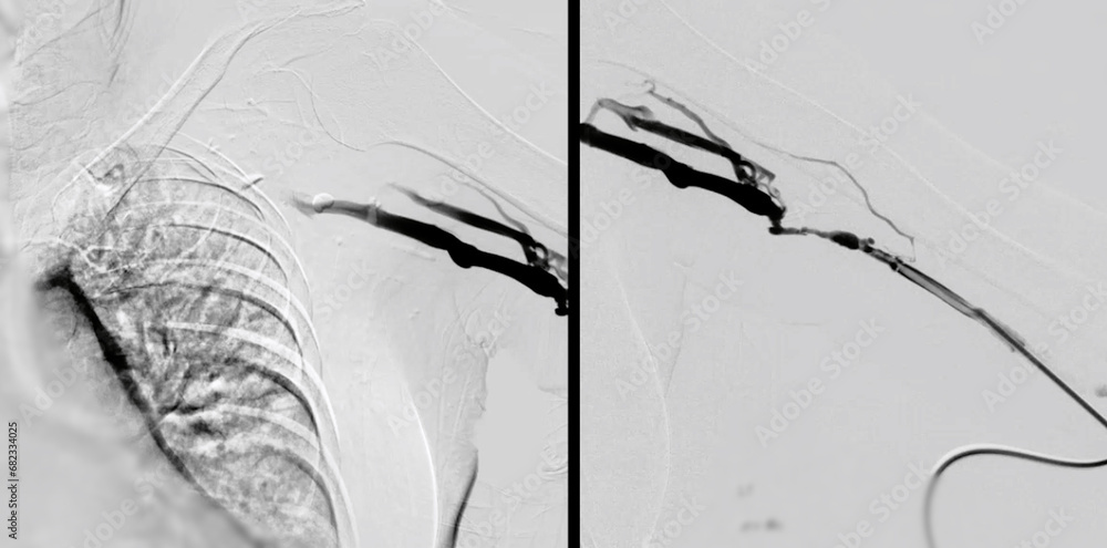 Balloon Angioplasty is a medical procedure used to widen narrowed or ...