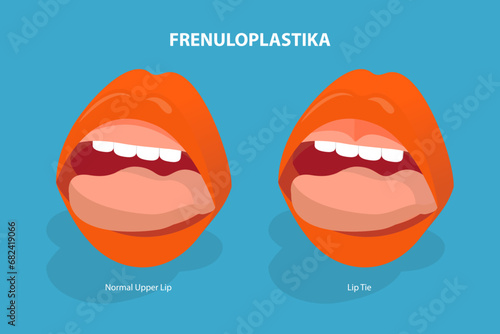 3D Isometric Flat Vector Illustration of Frenuloplastika, Lip Tie Before and After Surgery
