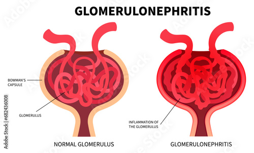 The Polycystic kidney cysts and stones with creatinine Peritoneal dialysis or hemodialysis for renal transplant