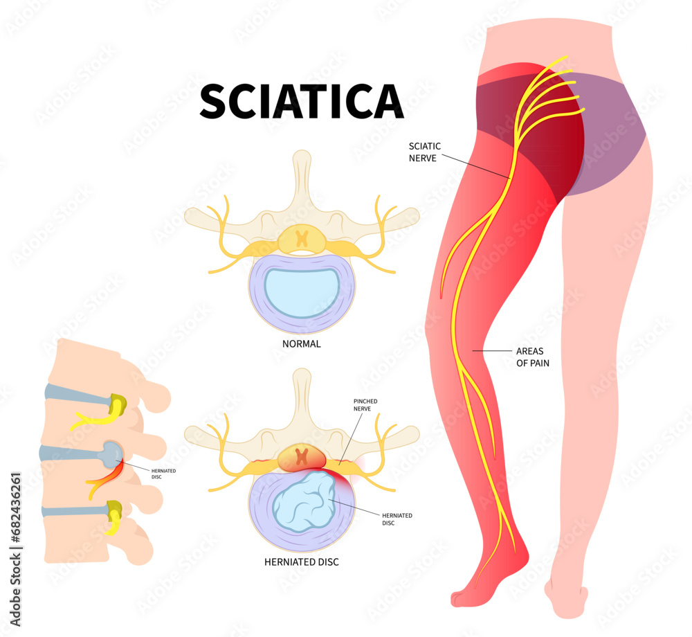 The Sciatica Nerve Pain Of Lower Back Through Hips To Leg And 