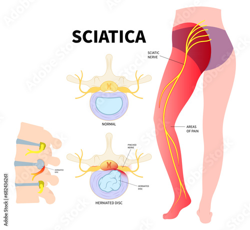 The Sciatica nerve pain of lower back through hips to leg and degenerative disc disease photo