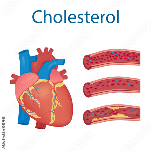 Atherosclerosis concept. enlarged artery with plaques. Medical vector illustration
