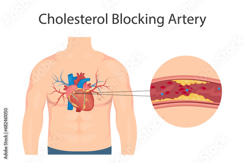Atherosclerosis concept, health risk. Human heart. Medical vector illustration