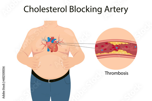 Atherosclerosis concept, health risk. Human heart. Medical vector illustration