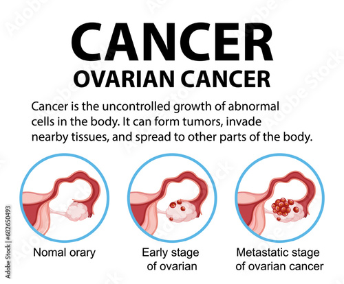Woman Ovarian Cancer Infographic: Stages and Anatomy