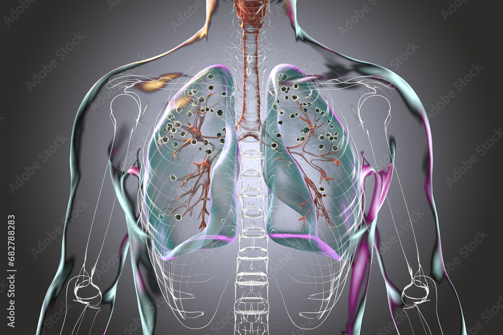 Human lungs with silicosis, 3D illustration - obrazy, fototapety, plakaty 