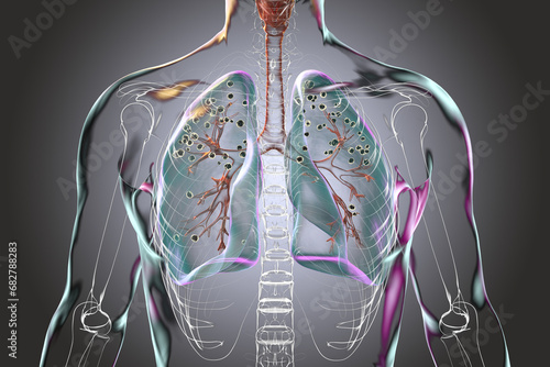 Human lungs with silicosis, 3D illustration photo