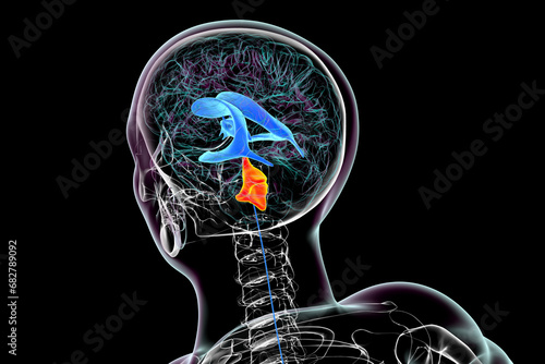 Enlargement of the fourth brain ventricle, 3D illustration