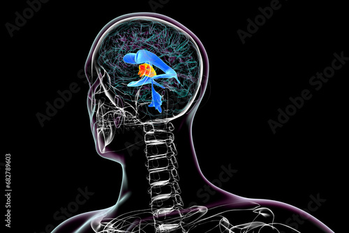 Quadro em tela Enlargement of the third brain ventricle, 3D illustration