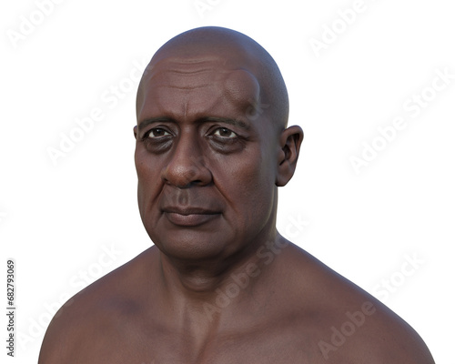 Lipoma on a man's forehead, 3D illustration photo