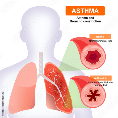 Asthma and Broncho constriction c section medical illustration