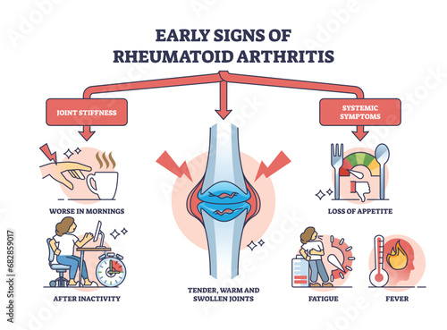Early signs of rheumatoid arthritis disease and joint pain outline diagram. Labeled educational stiffness and systemic symptom explanation vector illustration. Cartilage tender, warm and swollen.