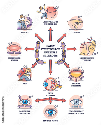 Early symptoms of multiple sclerosis and MS affected things outline diagram. Labeled educational medical scheme with potential problems after diagnosed illness or body condition vector illustration. photo