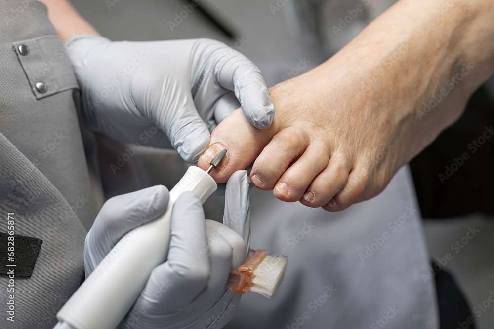 The process of filing off a thickened old nail from the fingers of an elderly woman. Procedure podologist. The process of filing off a thickened old nail from the fingers of an elderly woman. Procedure podologist.