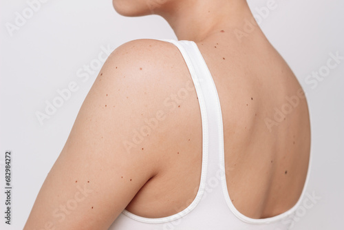 Cropped shot of a young woman with a large number of moles isolated on a white background. The effect of sunlight on the skin. Birthmarks on the female body