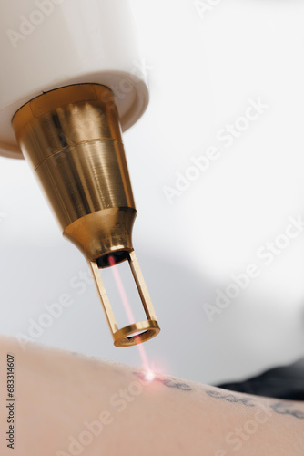 Cuadro en lienzo Procedure undergoing laser tattoo removal on hand of young woman in salon, close