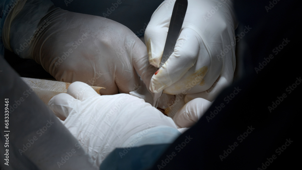 Surgery operation close up. Action. Surgeon hands performing operation with surgery tools.