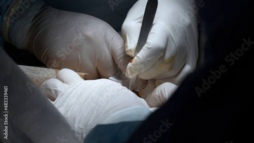 Surgery operation close up. Action. Surgeon hands performing operation with surgery tools.