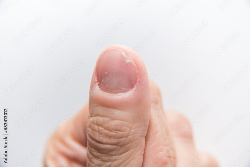 Fototapeta premium close up, fingernail, dead root nail, onychogaphy, dermatology, fingernail