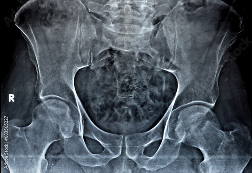 Plain X-ray of both hip joints revealed slight narrowing of superolateral aspect of both hip joints spaces with subchondral sclerosis of the opposed acetabular denoting osteoarthritic changes photo