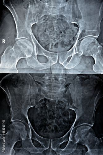 Plain X-ray of both hip joints revealed slight narrowing of superolateral aspect of both hip joints spaces with subchondral sclerosis of the opposed acetabular denoting osteoarthritic changes photo