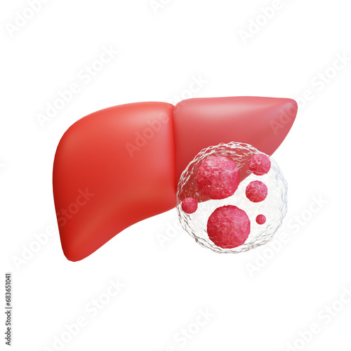 Liver cancer hepatoma , Hepatocellular Carcinoma, causes and treatment. 3d illustration icon photo