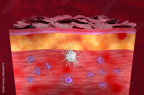 Inflammatory skin in Eczema, Atopic Dermatitis (AD) - isometric view 3d illustration photo