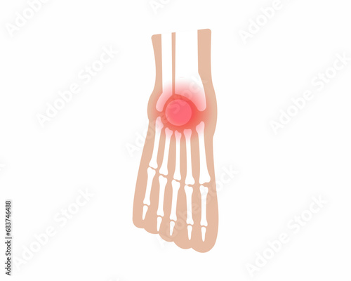 Pain in foot joints Arthritis foot joint pain syndrome foot Skeleton Bones Pain Injury and Inflammation vector illustration.
