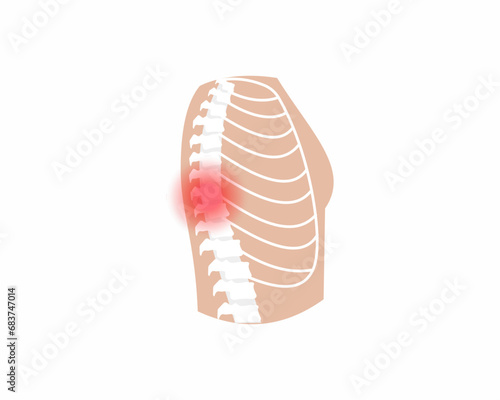 Pain in spin joint Arthritis back joint pain syndrome spin Skeleton Bones Pain Injury and Inflammation vector illustration.
