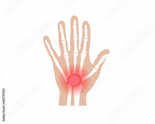 Pain in finger joints Arthritis finger joint pain syndrome finger Skeleton Bones Pain Injury and Inflammation vector illustration.