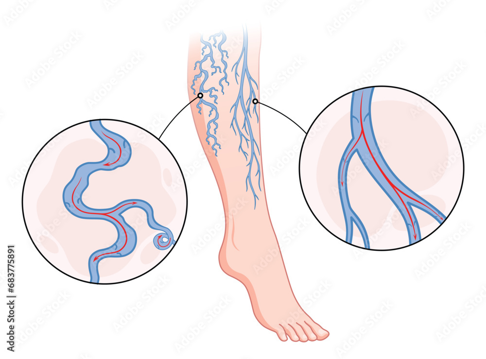 Varicose veins. Blue blood vessel visible through the skin, abnormally ...