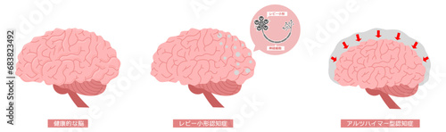 脳の病気　認知症※Affinity Designer作成svgファイル	