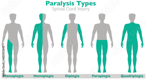 Paralysis types, palsy, spinal cord injury. Hemiplegia, diplegia, monoplegia, paraplegia, quadriplegia.  causes, stroke, tumor, nerve damage 
brain injuries. Side man human body. Illustration vector #683953843