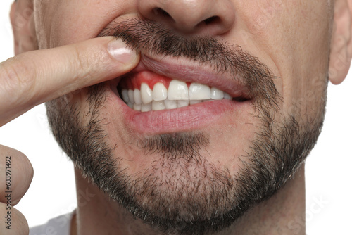 Man showing inflamed gum on white background  closeup