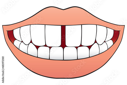 Tooth Gap