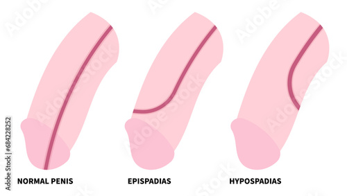 Genetic disorder with reproductive system that show abnormality of the urethra opening called Hypospadias photo