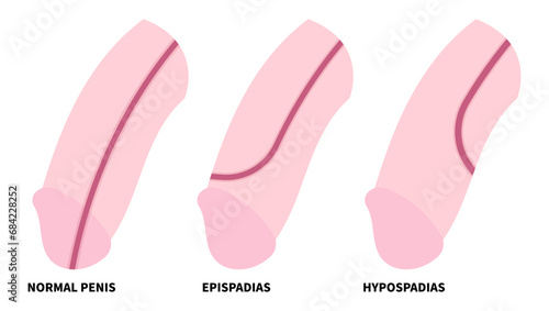 Genetic disorder with reproductive system that show abnormality of the urethra opening called Hypospadias